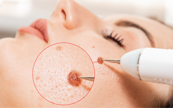 Skin Tag Removal
